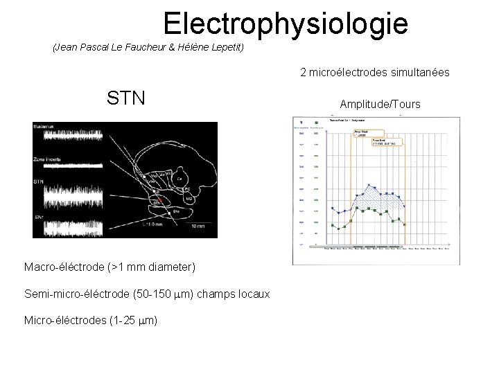 Electrophysiologie (Jean Pascal Le Faucheur & Hélène Lepetit) 2 microélectrodes simultanées STN Macro-éléctrode (>1