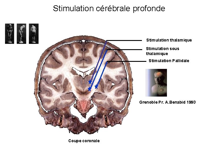 Stimulation cérébrale profonde Stimulation thalamique Stimulation sous thalamique Stimulation Pallidale Grenoble Pr. A. Benabid