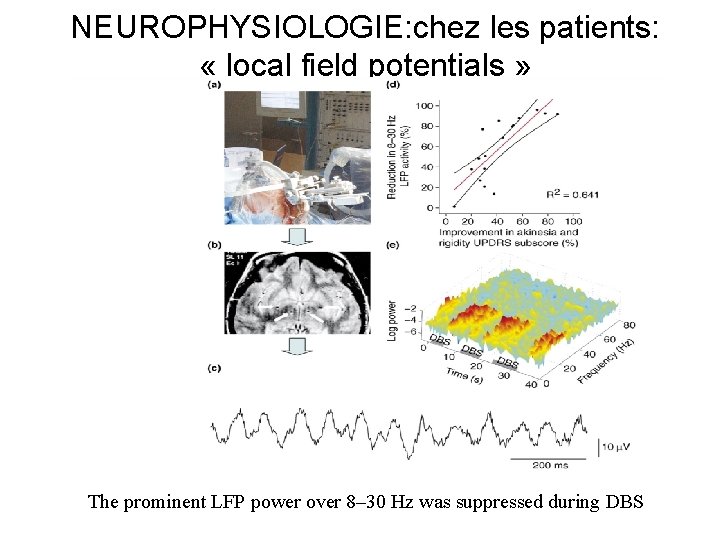 NEUROPHYSIOLOGIE: chez les patients: « local field potentials » The prominent LFP power over