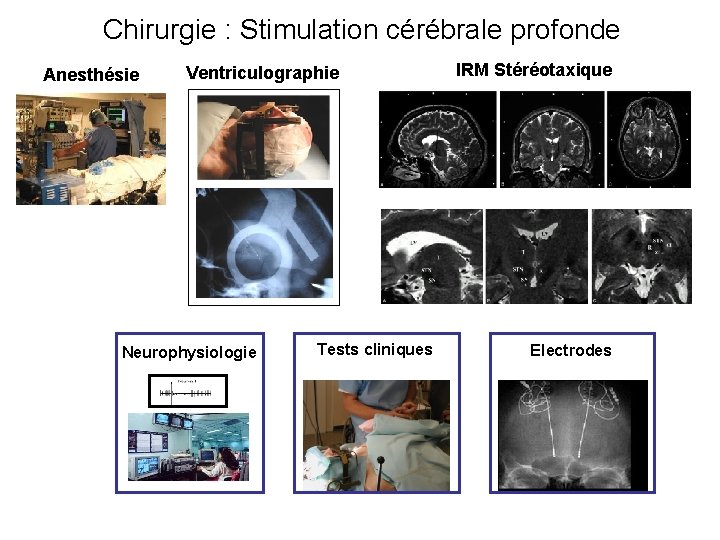 Chirurgie : Stimulation cérébrale profonde Anesthésie Ventriculographie Neurophysiologie Tests cliniques IRM Stéréotaxique Electrodes 