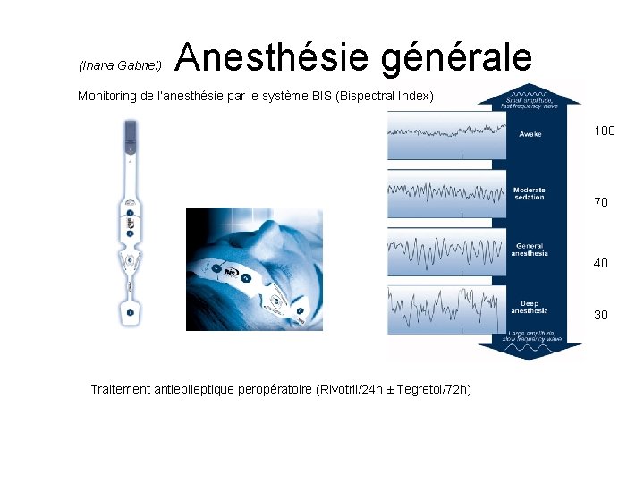 (Inana Gabriel) Anesthésie générale Monitoring de l’anesthésie par le système BIS (Bispectral Index) 100