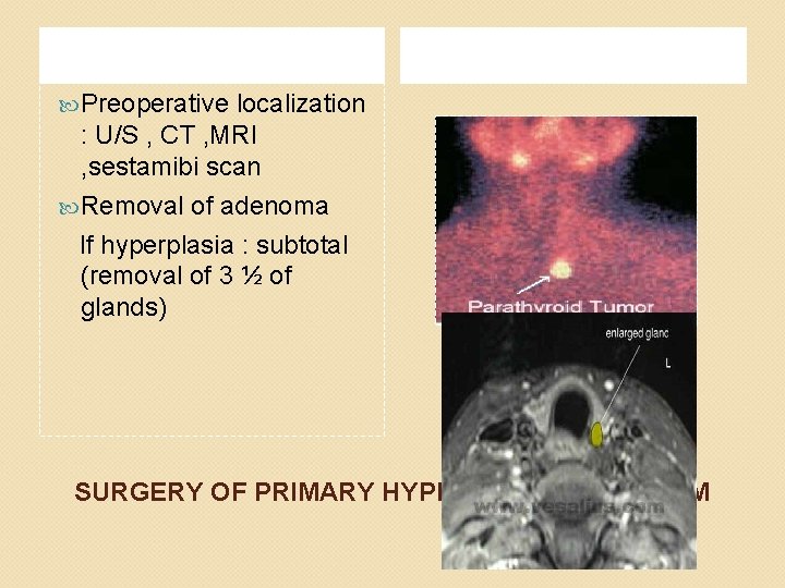  Preoperative localization : U/S , CT , MRI , sestamibi scan Removal of