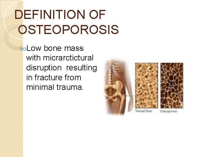 DEFINITION OF OSTEOPOROSIS Low bone mass with micrarctictural disruption resulting in fracture from minimal