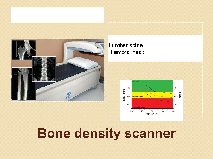 Lumbar spine Femoral neck Bone density scanner 