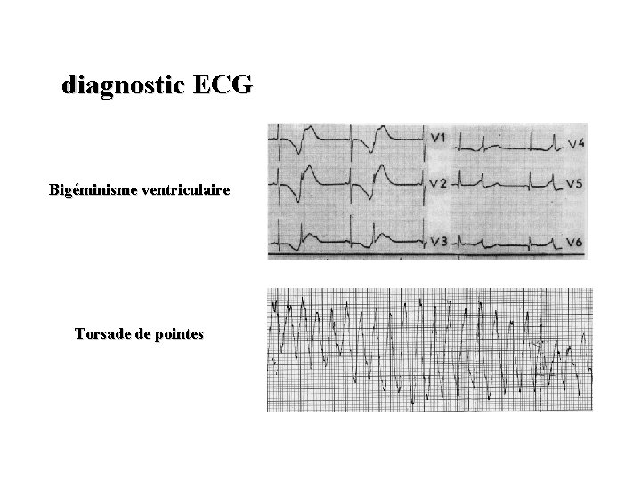  diagnostic ECG Bigéminisme ventriculaire Torsade de pointes 