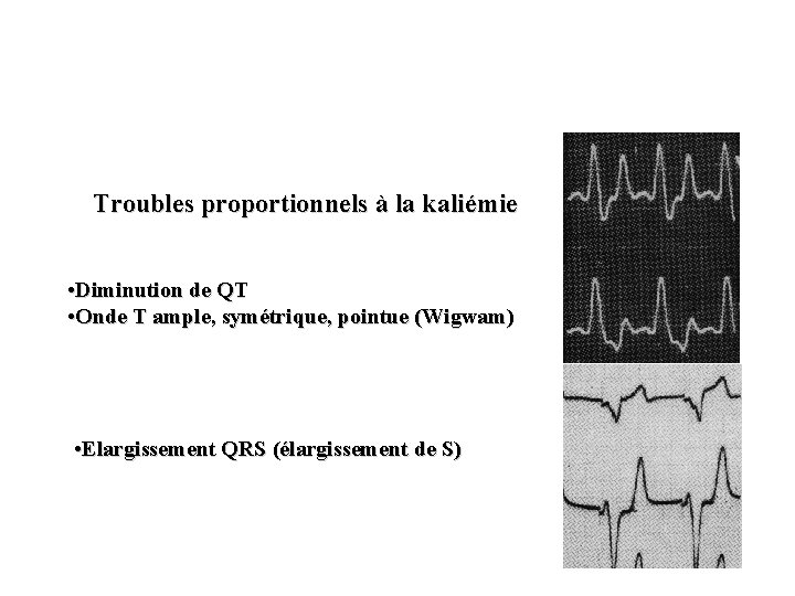 Troubles proportionnels à la kaliémie • Diminution de QT • Onde T ample, symétrique,