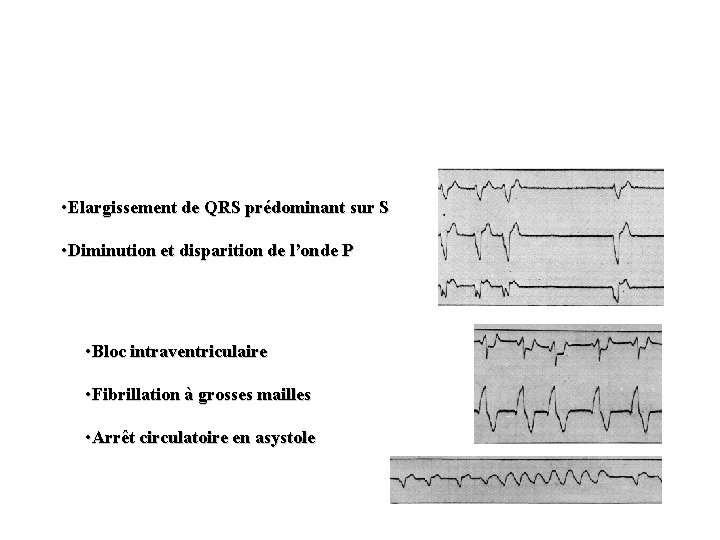  • Elargissement de QRS prédominant sur S • Diminution et disparition de l’onde