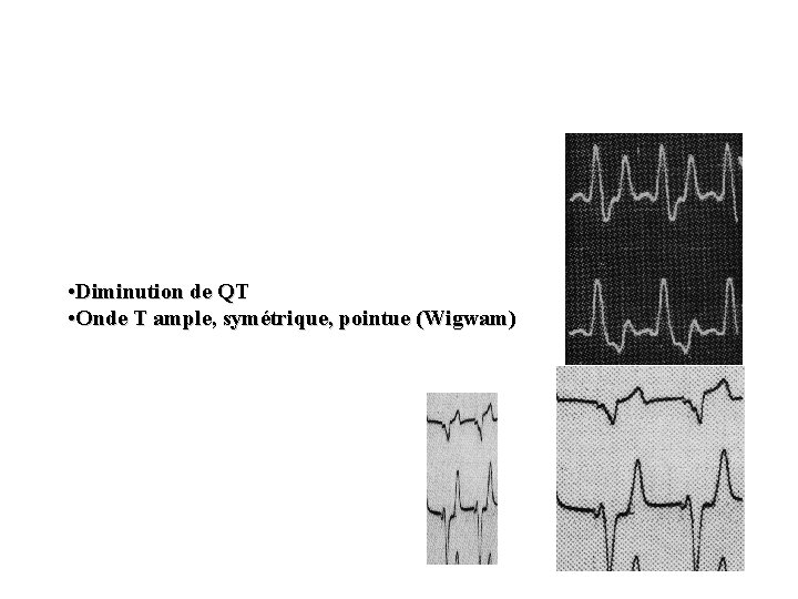  • Diminution de QT • Onde T ample, symétrique, pointue (Wigwam) 