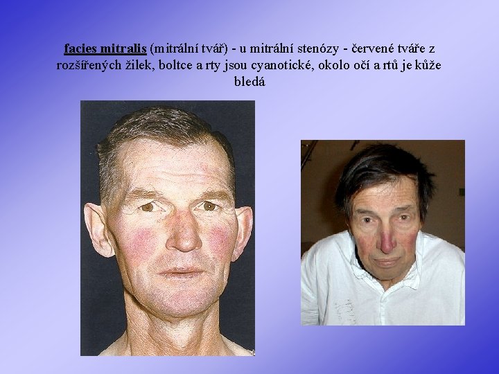 facies mitralis (mitrální tvář) - u mitrální stenózy - červené tváře z rozšířených žilek,