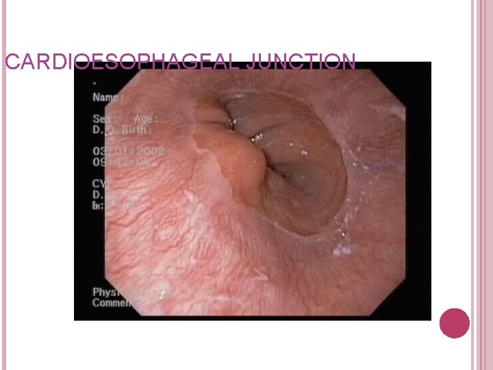 CARDIOESOPHAGEAL JUNCTION CARDIOESOPHAGEAL JUNCTION