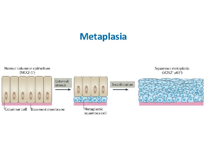 Metaplasia 