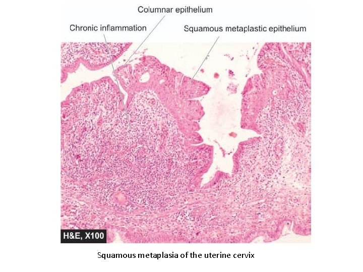 Squamous metaplasia of the uterine cervix 