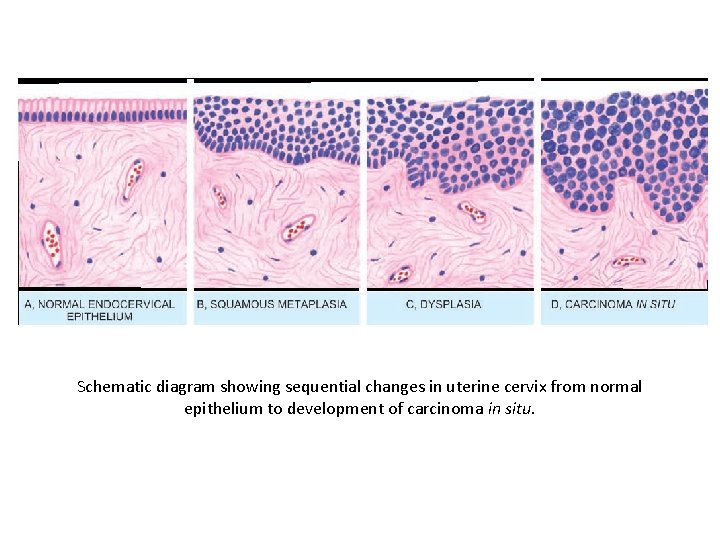 Schematic diagram showing sequential changes in uterine cervix from normal epithelium to development of