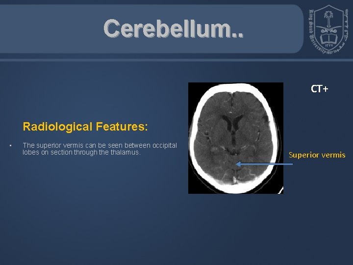 Cerebellum. . CT+ Radiological Features: • The superior vermis can be seen between occipital
