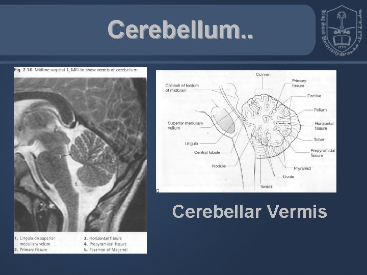 Cerebellum. . Cerebellar Vermis 