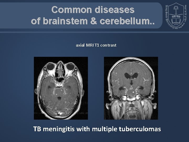 Common diseases of brainstem & cerebellum. . axial MRI T 1 contrast TB meningitis