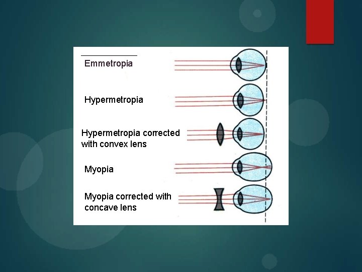 Emmetropia Hypermetropia corrected with convex lens Myopia corrected with concave lens 