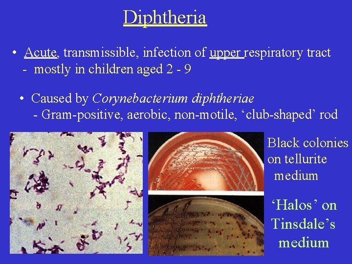 Diphtheria • Acute, transmissible, infection of upper respiratory tract - mostly in children aged