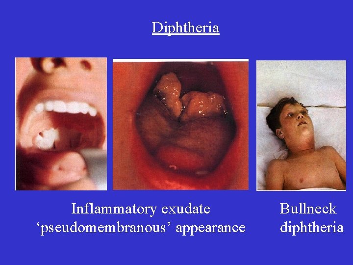 Diphtheria Inflammatory exudate ‘pseudomembranous’ appearance Bullneck diphtheria 