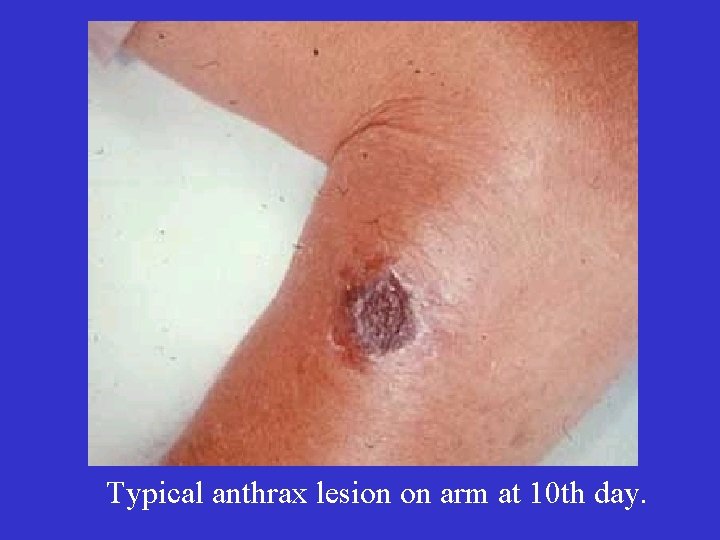 Typical anthrax lesion on arm at 10 th day. 