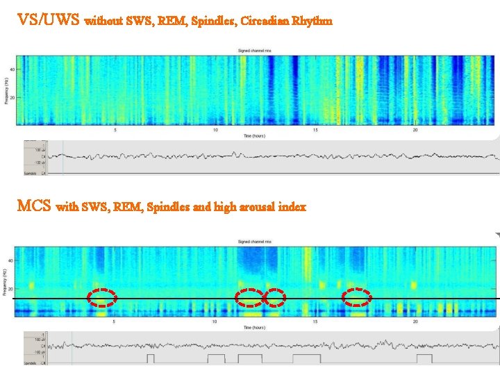 VS/UWS without SWS, REM, Spindles, Circadian Rhythm MCS with SWS, REM, Spindles and high
