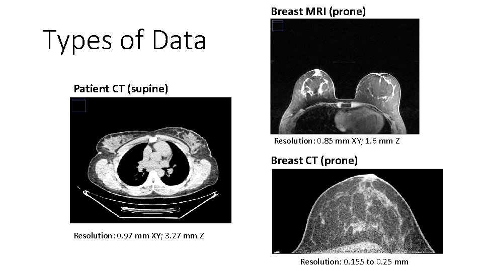 Breast MRI (prone) Types of Data Patient CT (supine) Resolution: 0. 85 mm XY;