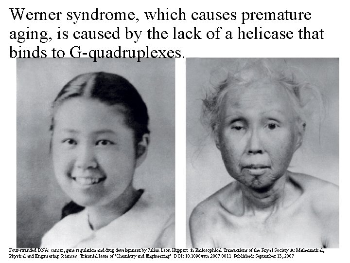 Werner syndrome, which causes premature aging, is caused by the lack of a helicase