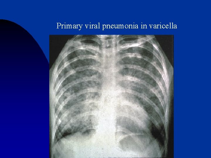 Primary viral pneumonia in varicella 