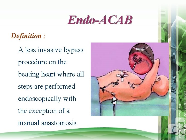 Endo-ACAB Definition : A less invasive bypass procedure on the beating heart where all