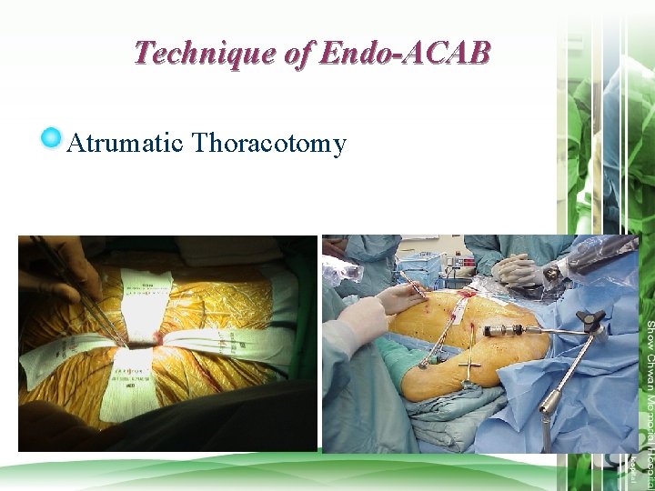 Technique of Endo-ACAB Atrumatic Thoracotomy 