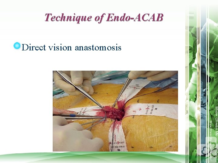 Technique of Endo-ACAB Direct vision anastomosis 
