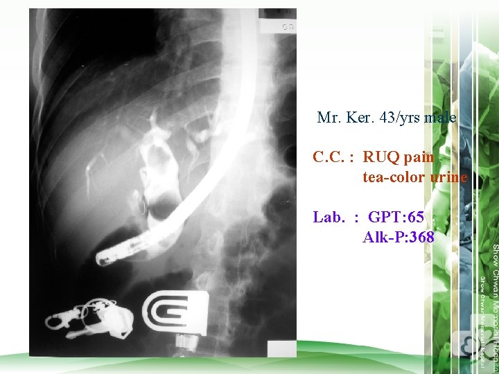 Mr. Ker. 43/yrs male C. C. : RUQ pain tea-color urine Lab. : GPT:
