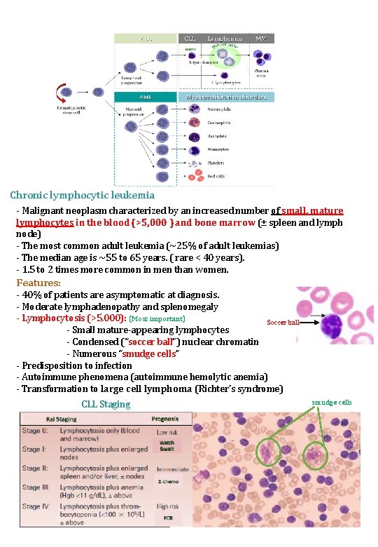 Chronic lymphocytic leukemia - Malignant neoplasm characterized by an increased number of small, mature