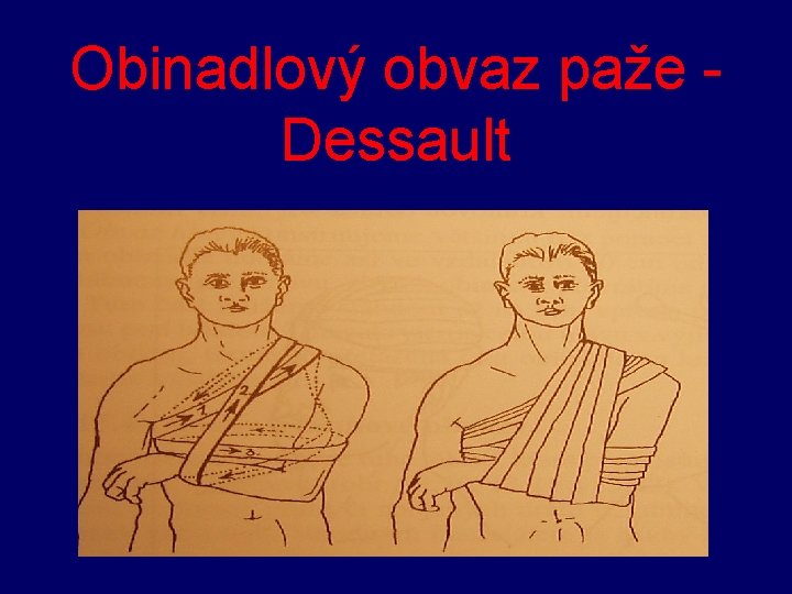 Obinadlový obvaz paže Dessault 