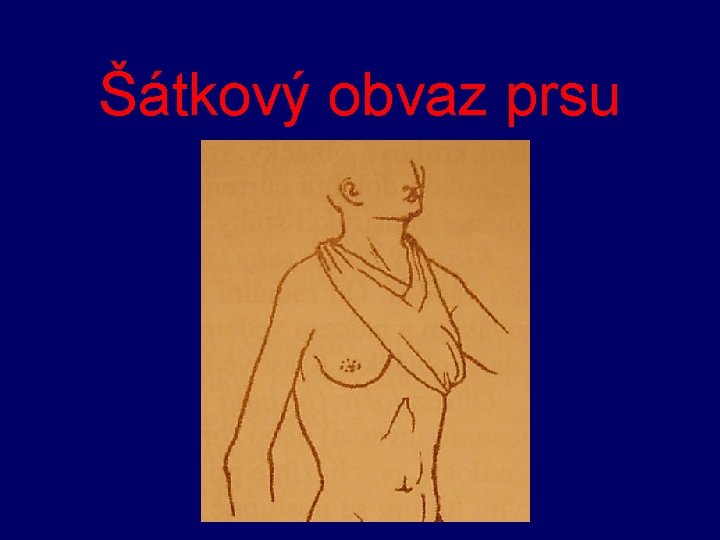 Šátkový obvaz prsu 