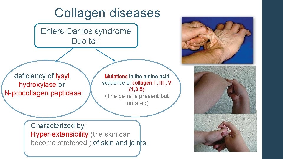 Collagen diseases Ehlers-Danlos syndrome Duo to : deficiency of lysyl hydroxylase or N-procollagen peptidase