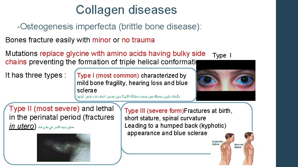 Collagen diseases -Osteogenesis imperfecta (brittle bone disease): Bones fracture easily with minor or no