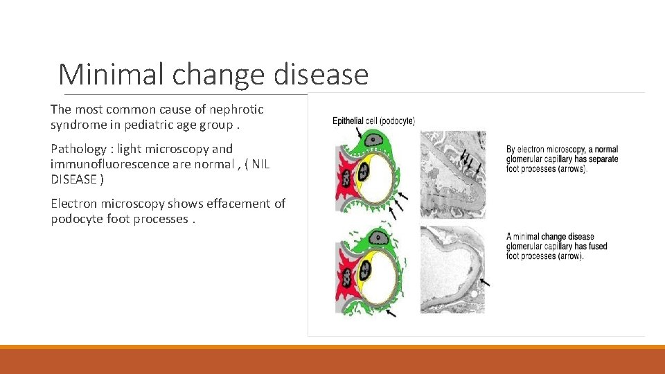 Minimal change disease The most common cause of nephrotic syndrome in pediatric age group.