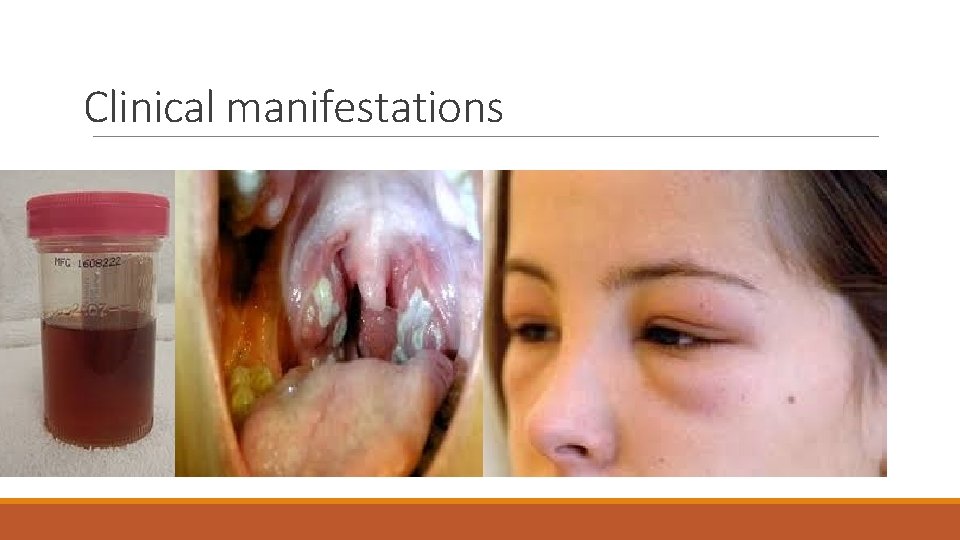 Clinical manifestations 
