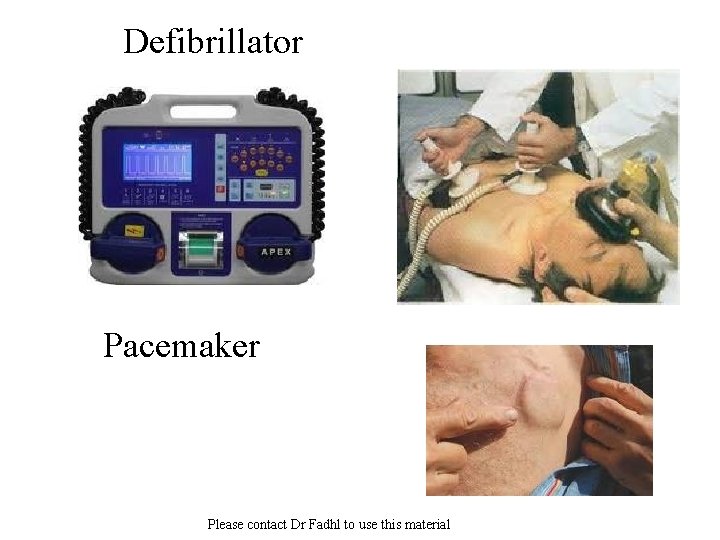 Defibrillator Pacemaker Please contact Dr Fadhl to use this material 