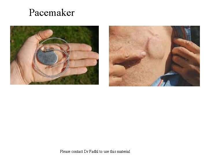 Pacemaker Please contact Dr Fadhl to use this material 