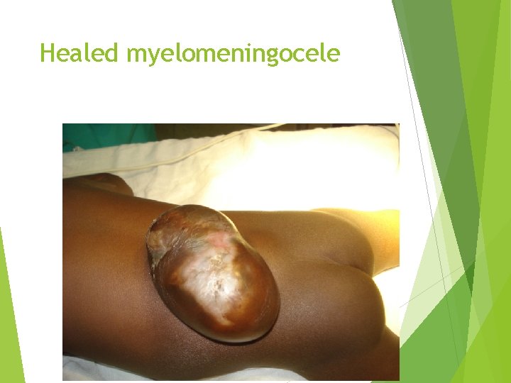 Healed myelomeningocele 