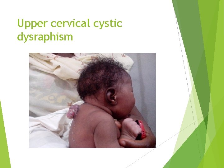Upper cervical cystic dysraphism 