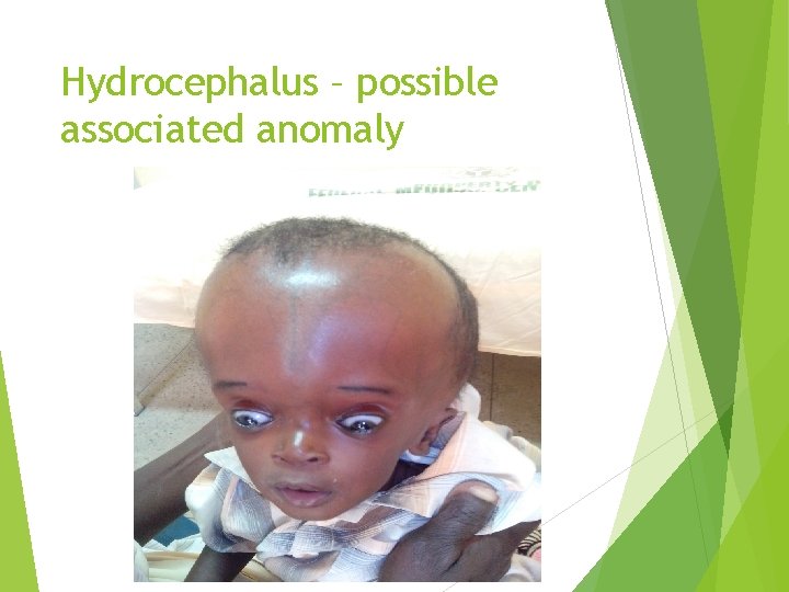 Hydrocephalus – possible associated anomaly 