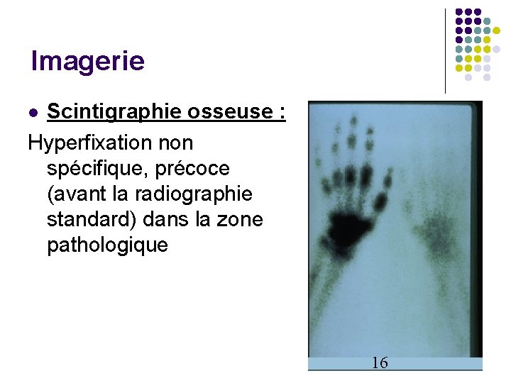 Imagerie Scintigraphie osseuse : Hyperfixation non spécifique, précoce (avant la radiographie standard) dans la