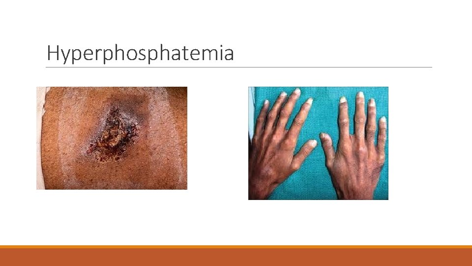 Hyperphosphatemia 