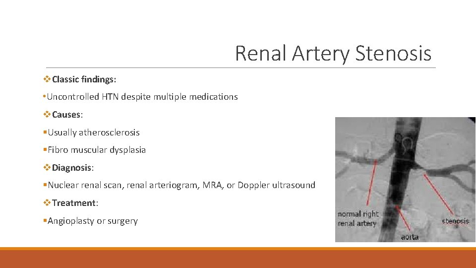 Renal Artery Stenosis v. Classic findings: • Uncontrolled HTN despite multiple medications v. Causes: