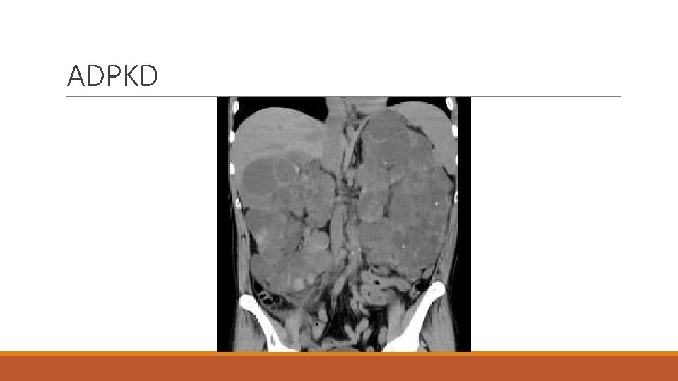 ADPKD 