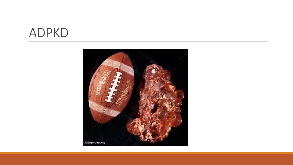 ADPKD 