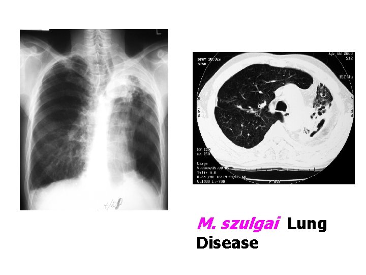 M. szulgai Lung Disease 
